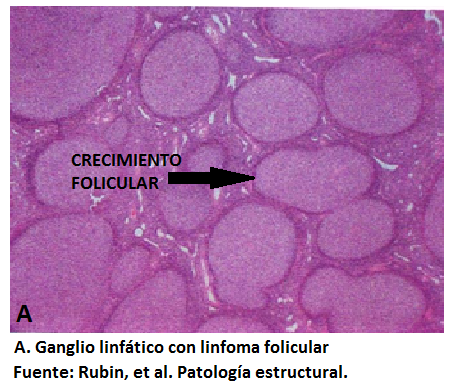 Folicular linfoma que un es